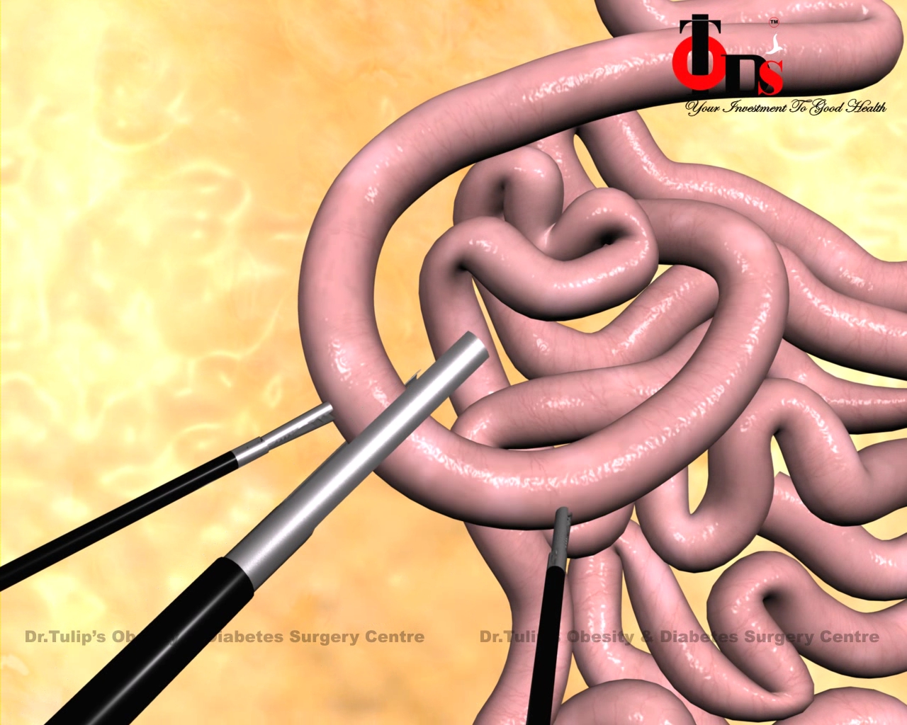  Haital Hernia surgery